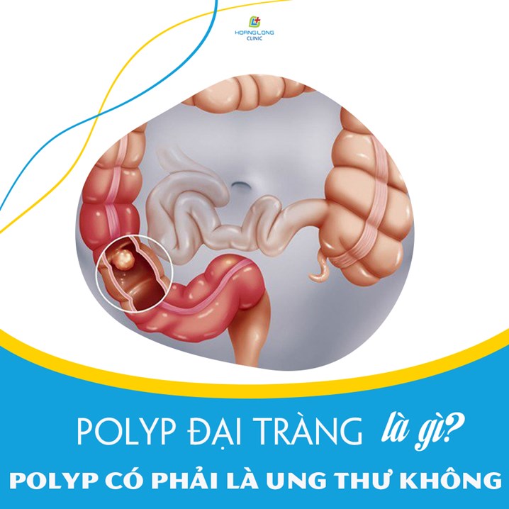 Polyp đại tràng là gì? Polyp đại tràng có phải ung thư không?