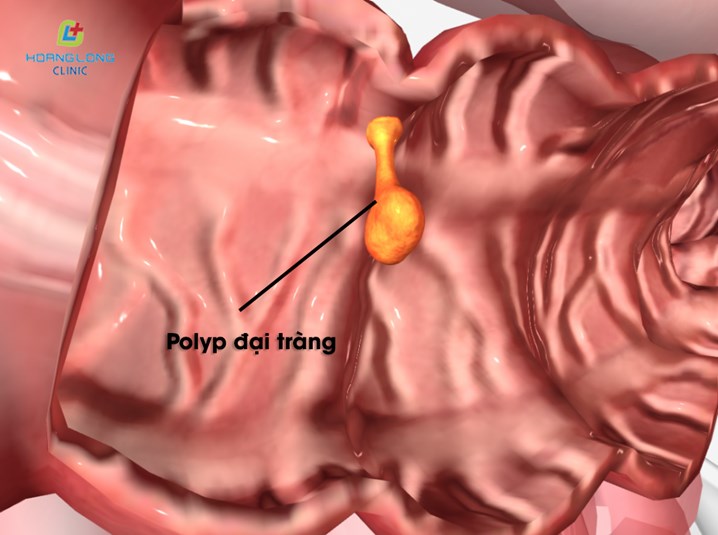 Polyp đại tràng là gì?