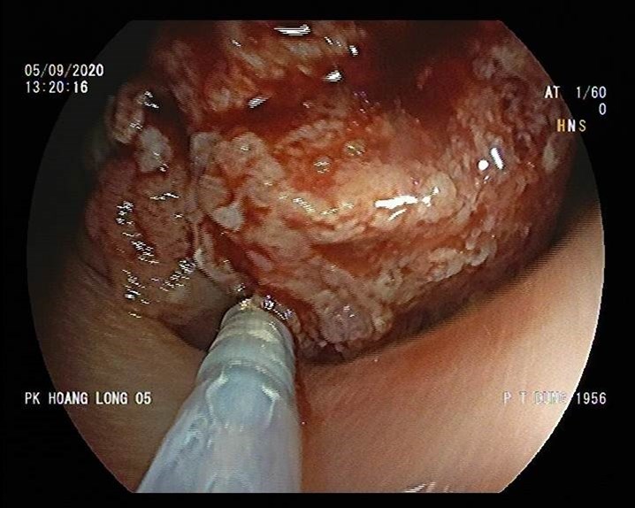 nội soi đại tràng, nội soi trực tràng, polyp trực tràng