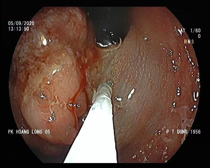 polyp trực tràng của bệnh nhân Phan Tiến.D