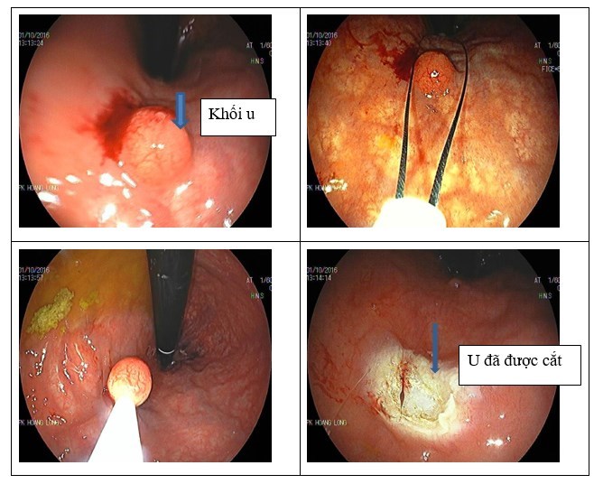 Hình ảnh khổi u carcinoid