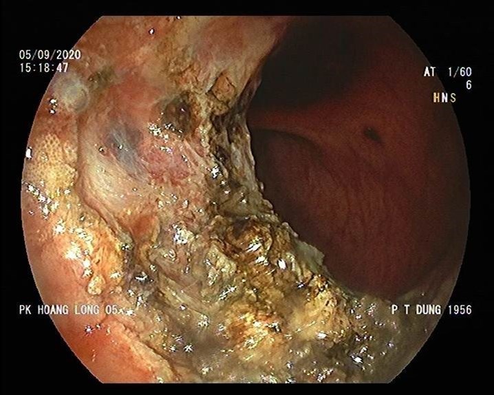 nội soi đại tràng, nội soi trực tràng, polyp trực tràng