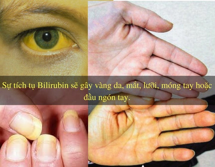 Vàng da có thể cảnh báo về bệnh viêm gan