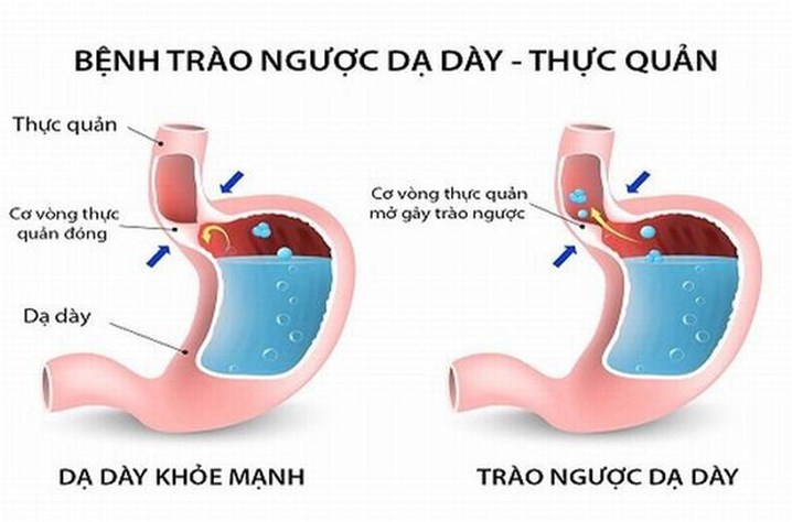 Esophageal reflux disease (illustration)