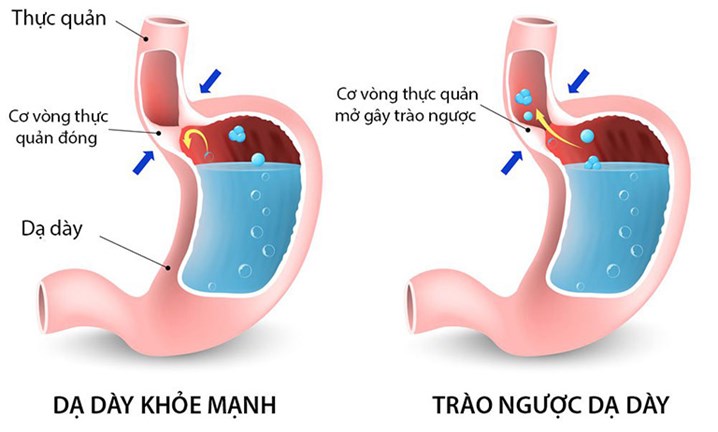 trào ngược dạ dày thực quản, trào ngược dạ dày, trào ngược dạ dày thực quản độ A