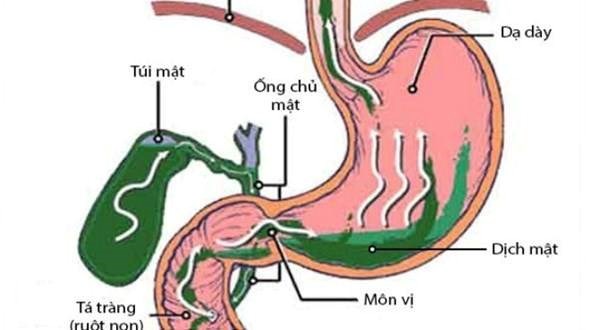 Trào ngược dịch mật là gì?