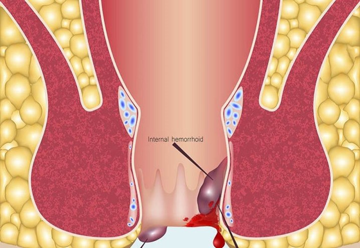 bệnh trĩ huyết khối, trĩ nội huyết khối, trĩ ngoại, điều trị bệnh trĩ