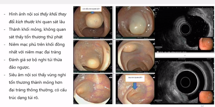 ứng dụng trí tuệ nhân tạo trong nội soi tiêu hoá, nội soi tiêu hoá, ung thư đường tiêu hoá sớm, làm sạch đại tràng