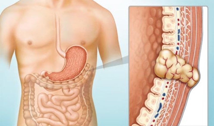 u dưới niêm mạc đường tiêu hoá, siêu âm nội soi, nội soi tiêu hoá