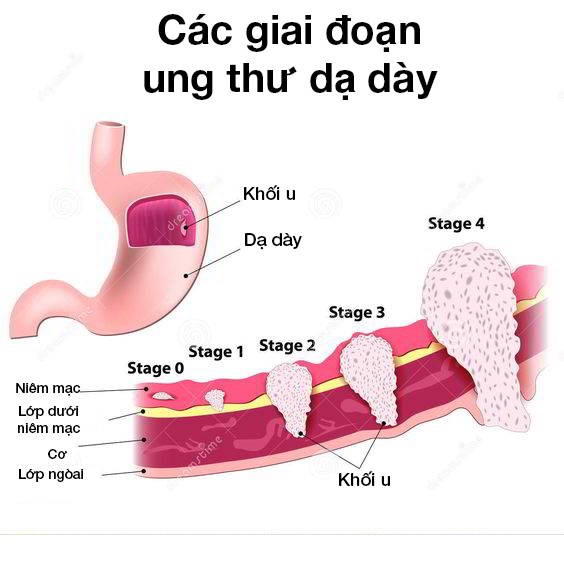 ung thư dạ dày, ung thư dạ dày có mấy giai đoạn, ung thư dạ dày giai đoạn sớm