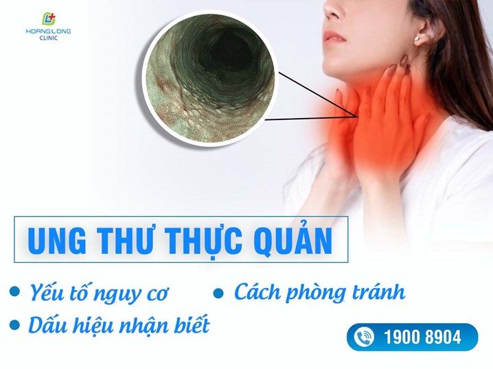 Ung thư thực quản: Yếu tố nguy cơ, dấu hiệu nhận biết và cách phòng tránh