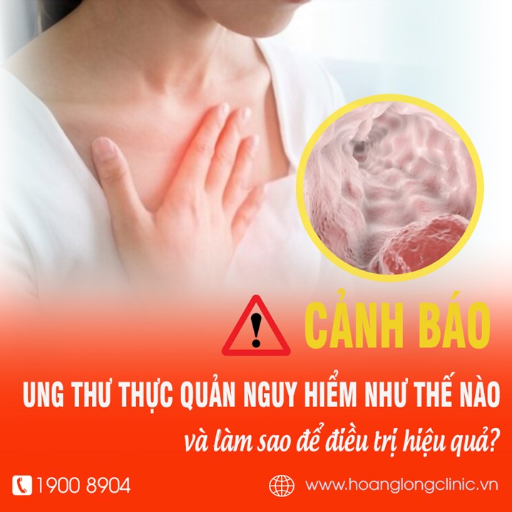 Ung thư thực quản nguy hiểm như thế nào và làm sao để điều trị hiệu quả