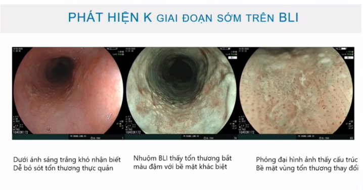 ứng dụng trí tuệ nhân tạo trong nội soi tiêu hoá, nội soi tiêu hoá, ung thư đường tiêu hoá sớm, làm sạch đại tràng