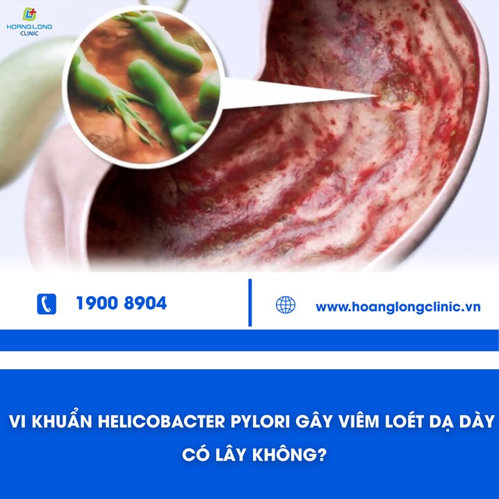 Vi khuẩn Helicobacter Pylori gây viêm loét dạ dày có lây không?