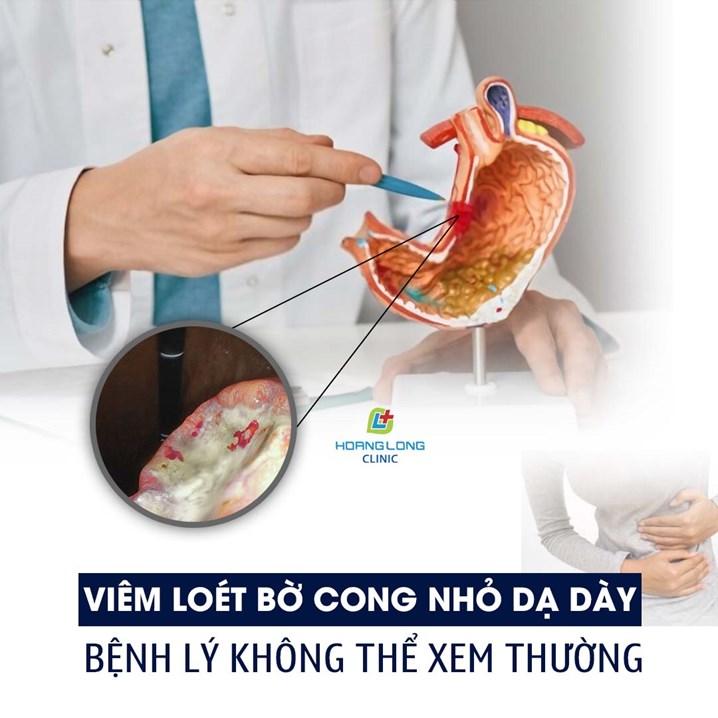 Viêm loét bờ cong nhỏ dạ dày bệnh lý không thể xem thường