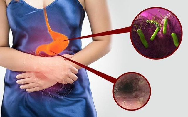 viêm teo niêm mạc dạ dày, ung thư dạ dày, vi khuẩn HP, viêm loét dạ dày, nội soi phóng đại công nghệ cao