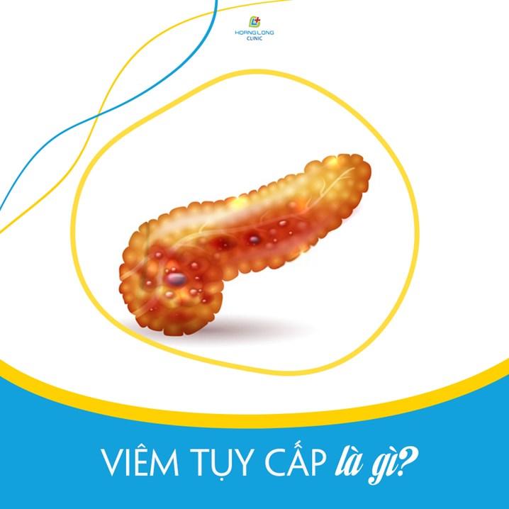 Viêm tụy cấp là gì?