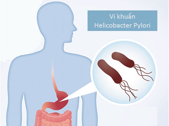 dị sản ruột ở dạ dày, viêm teo niêm mạc dạ dày, tiền ung thư dạ dày, vi khuẩn HP