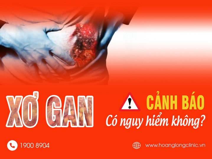 Xơ gan có nguy hiểm không?