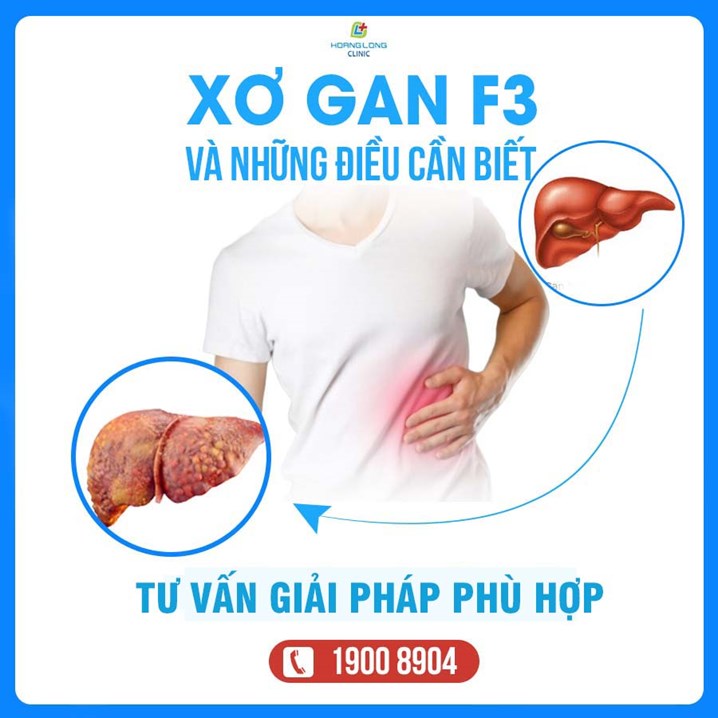 Xơ gan F3 và những điều cần biết