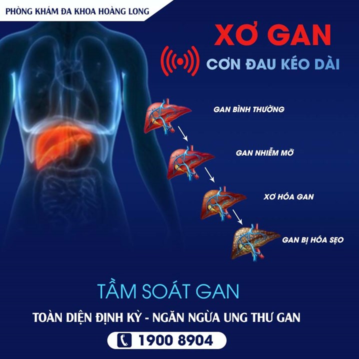 Bệnh xơ gan mang đến những cơn đau kéo dài thậm chí dẫn đến ung thư gan