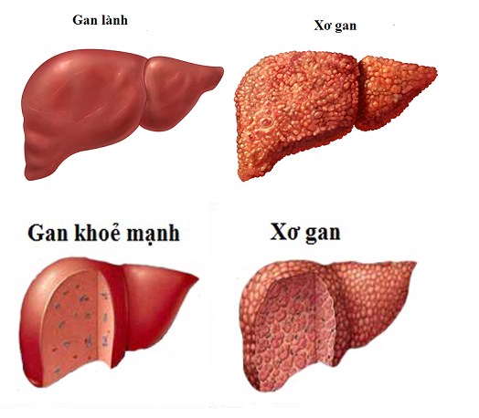 Bệnh xơ gan gây xuất huyết tiêu hóa, xơ gan gây xuất huyết tiêu hóa, xơ gan xuất huyết tiêu hóa