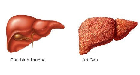 xơ gan F4 là gì, xơ gan F4, xơ gan F4 có chữa được không