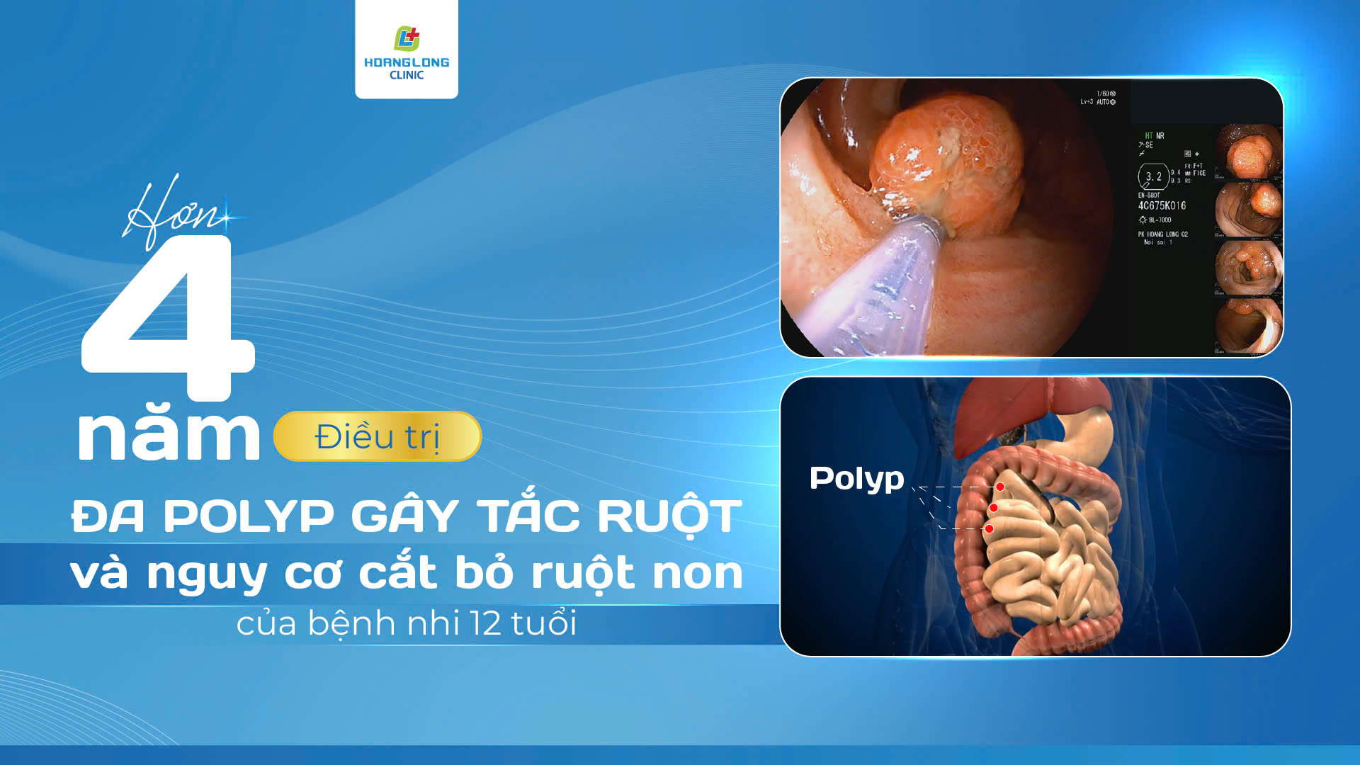 HƠN 4 NĂM ĐIỀU TRỊ ĐA POLYP GÂY TẮC RUỘT VÀ NGUY CƠ CẮT BỎ RUỘT NON CỦA BỆNH NHI 12 TUỔI