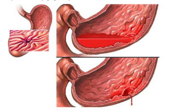 Xuất huyết tiêu hóa là bệnh gì?