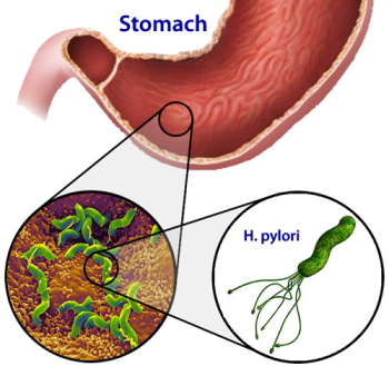 Vi khuẩn Helicobacter Pylori gây viêm loét dạ dày có lây không?