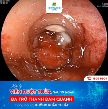 VIÊM RUỘT THỪA 10 NGÀY CÓ NGUY CƠ VỠ RUỘT ĐƯỢC XỬ LÝ NỘI SOI KHÔNG CẦN PHẪU THUẬT TẠI PHÒNG KHÁM ĐA KHOA HOÀNG LONG