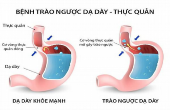 Trào ngược dạ dày trong thực quản và ngoài thực quản khác nhau như thế nào?