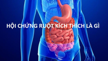 Hội chứng ruột kích thích