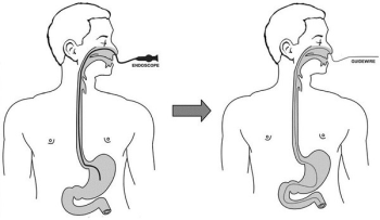 Quy trình nội soi dạ dày qua đường mũi