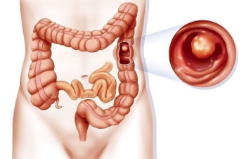 Polyp đại tràng là gì? Các phương pháp chẩn đoán polyp đại tràng