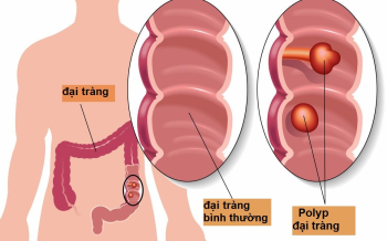 Những điều cần biết về cắt polyp đại tràng