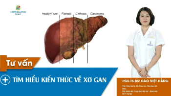 Xơ gan: Những lưu ý quan trọng về sức khỏe