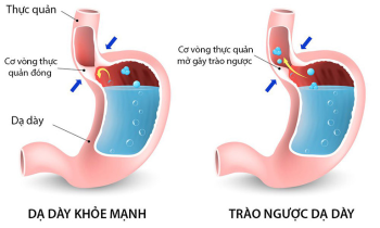 Tổng quan về bệnh trào ngược dạ dày thực quản (GERD) - Thực hành trong lâm sàng (Phần 1)