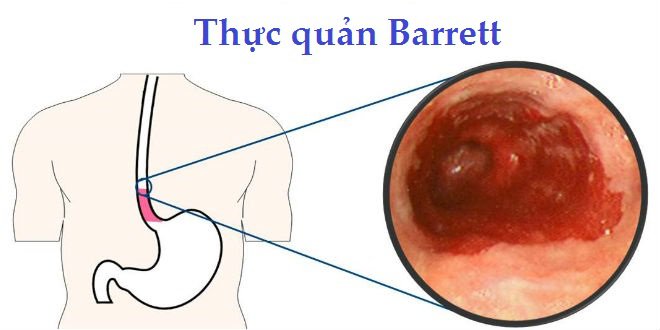 Barrett thực quản có thể tái phát lại không?