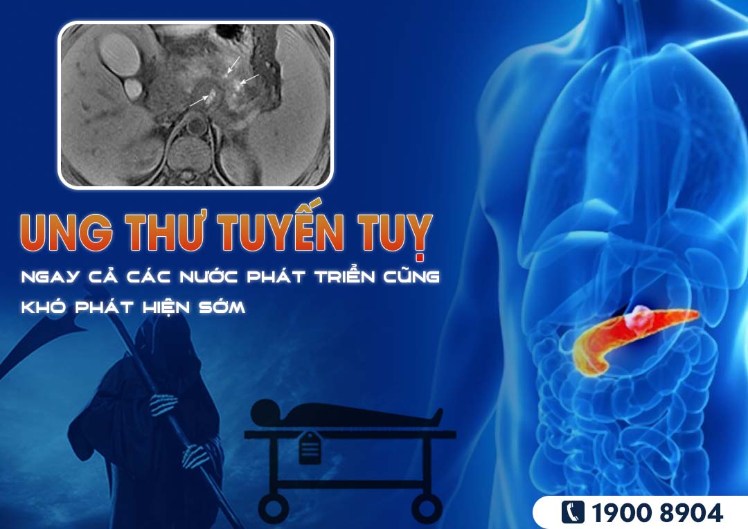 Ung thư tuyến tuỵ - Loại ung thư ngay cả các nước phát triển cũng khó phát hiện sớm