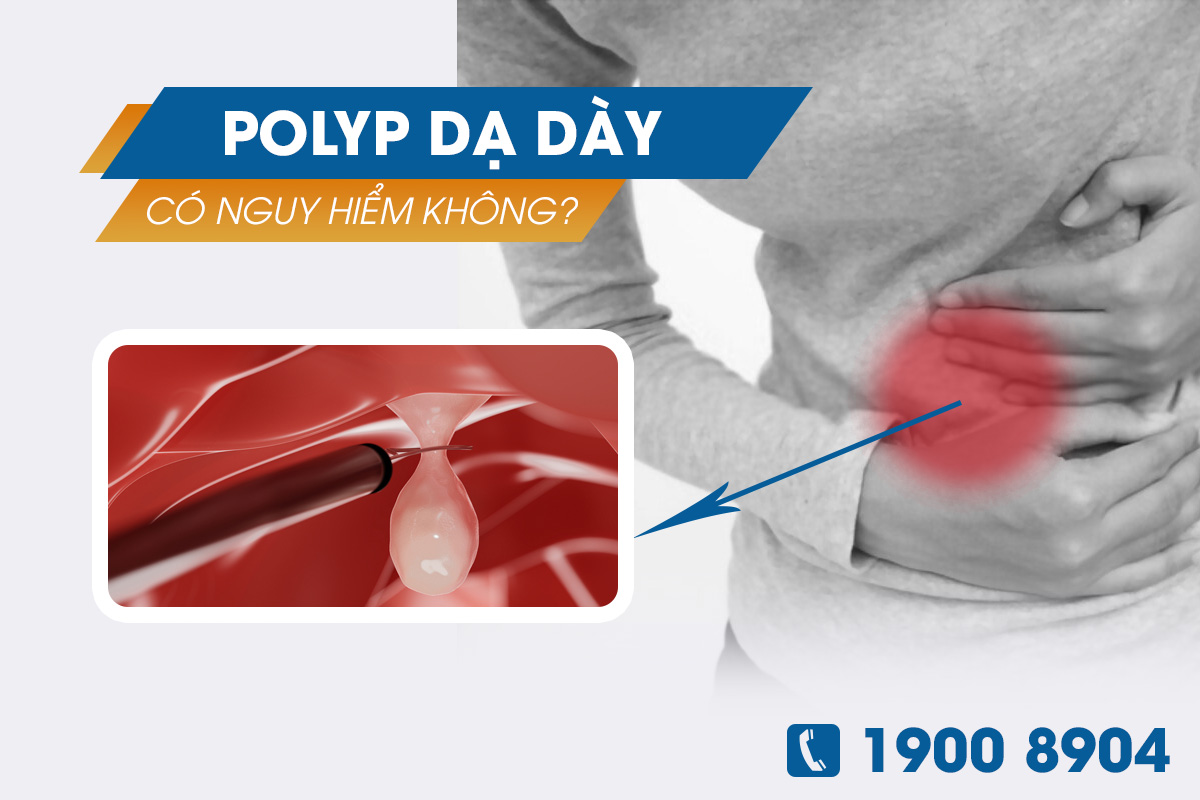 Polyp dạ dày có nguy hiểm không?