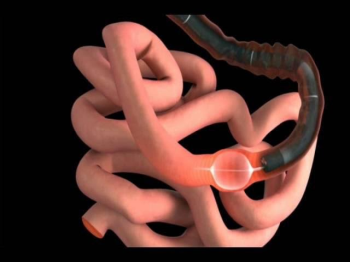 Current methods of small bowel endoscopy