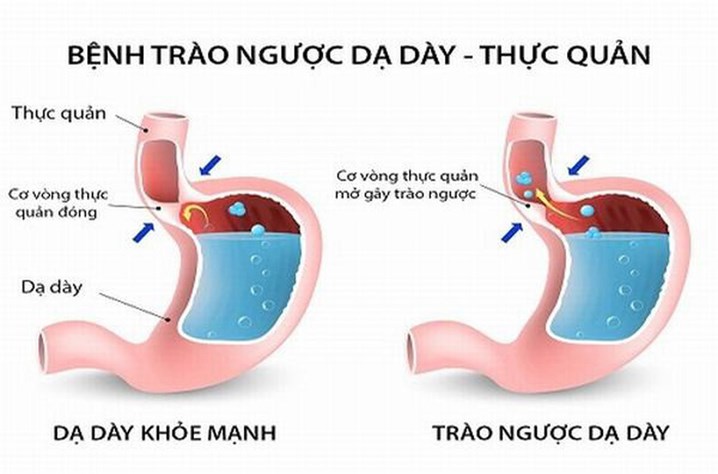 Trào ngược dạ dày thực quản - nên khám ở đâu?