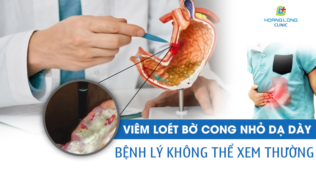 Viêm loét bờ cong nhỏ dạ dày - bệnh lý không thể xem thường