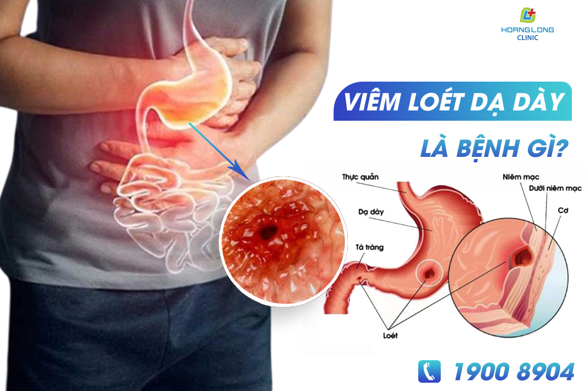 Viêm loét dạ dày là bệnh gì?