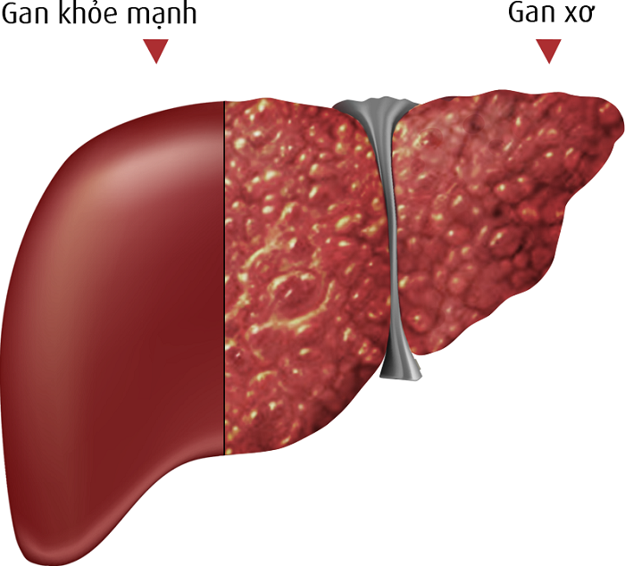 Xơ gan F3 và những điều cần biết